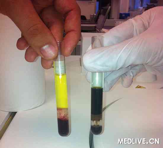 地中海贫血_贫血的人均出现紫绀