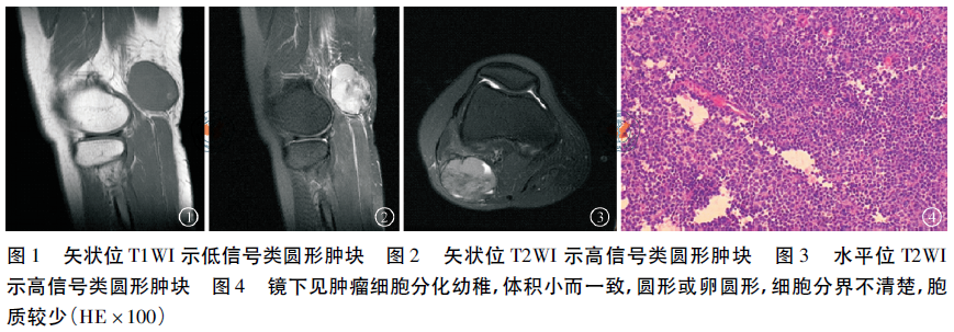 右腘窝骨外ewing肉瘤一例