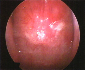 鼻咽部粘膜光滑,平坦,无明显隆起