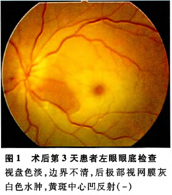 白内障术后视网膜中央动脉阻塞一例