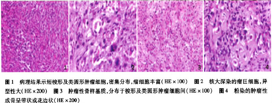 术后病理示:短梭形及类圆形细胞恶性肿瘤,瘤细胞丰富,生长活跃,可见瘤