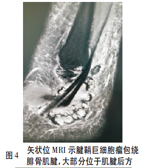 关节镜结合全层缝合法治疗外踝腓骨肌腱鞘巨细胞瘤1例