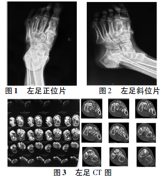 辅助检查:左足正斜位片示:左足踇趾近节趾骨,第1,2,3,4跖骨及内中外侧