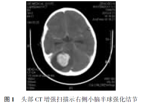 在治疗重型特重型颅脑伤时天幕切开术的应用