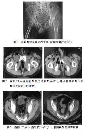 用缝合丝线结扎软垂疣48例体会