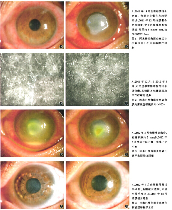 反复发作的阿米巴性角膜炎一例