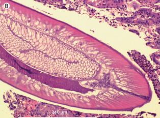 (病例)lancet:生吃海鱼导致异尖线虫病