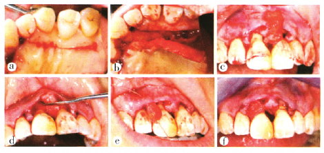 牙周膜龈手术结合冠修复重建缺失龈乳头1例