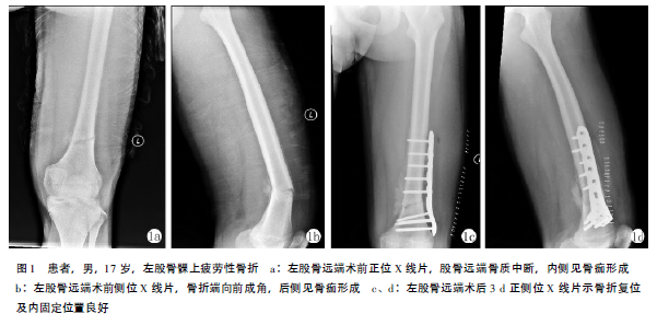 左股骨髁上疲劳性骨折诊治1例报告