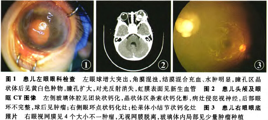 儿童三侧性视网膜母细胞瘤一例