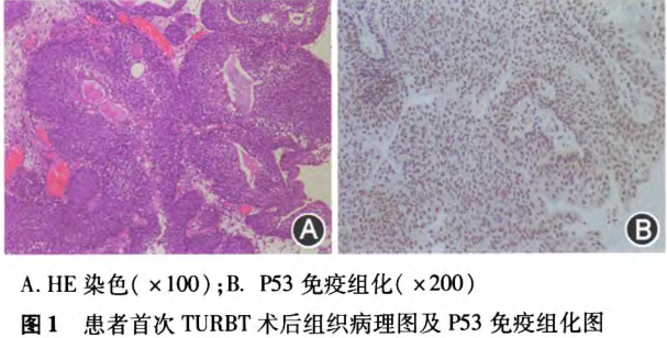 腺性膀胱炎临床误诊误治1例报告