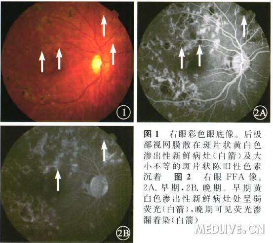 结核性多灶性脉络膜炎一例