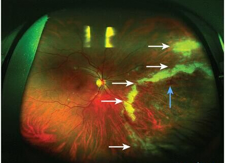 BMJ:巨细胞病毒性视网膜炎