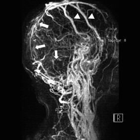 吃一堑长一智:静脉窦血栓误诊为蛛网膜下腔出
