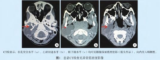 腮腺区肿物,是何原因
