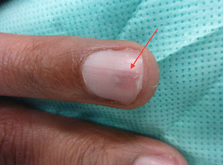 bmj长在指甲下面的血管球瘤