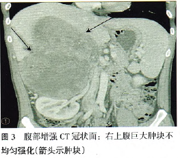 右上腹部包块,如何诊断?