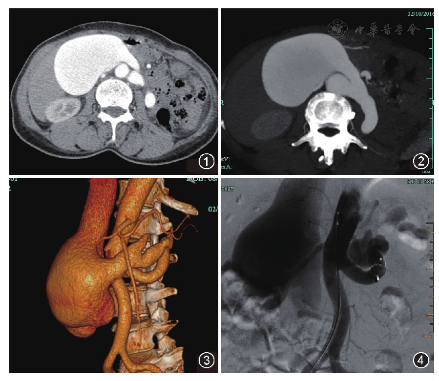 肾切除术后肾动静脉瘘并下腔静脉巨大瘤样扩张