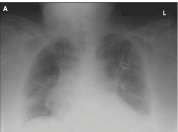 nejm:胸腔穿刺后出现血胸