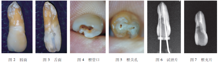 左上颌中切牙畸形根面沟并发双根管1例