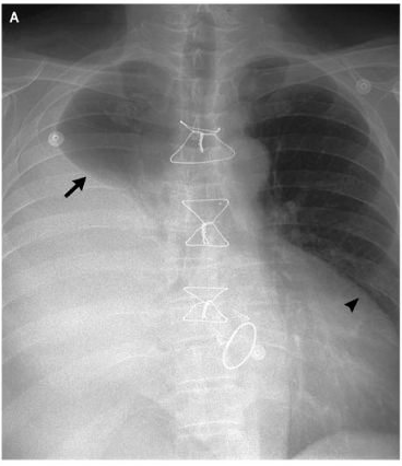 nejm:心包积气和气胸