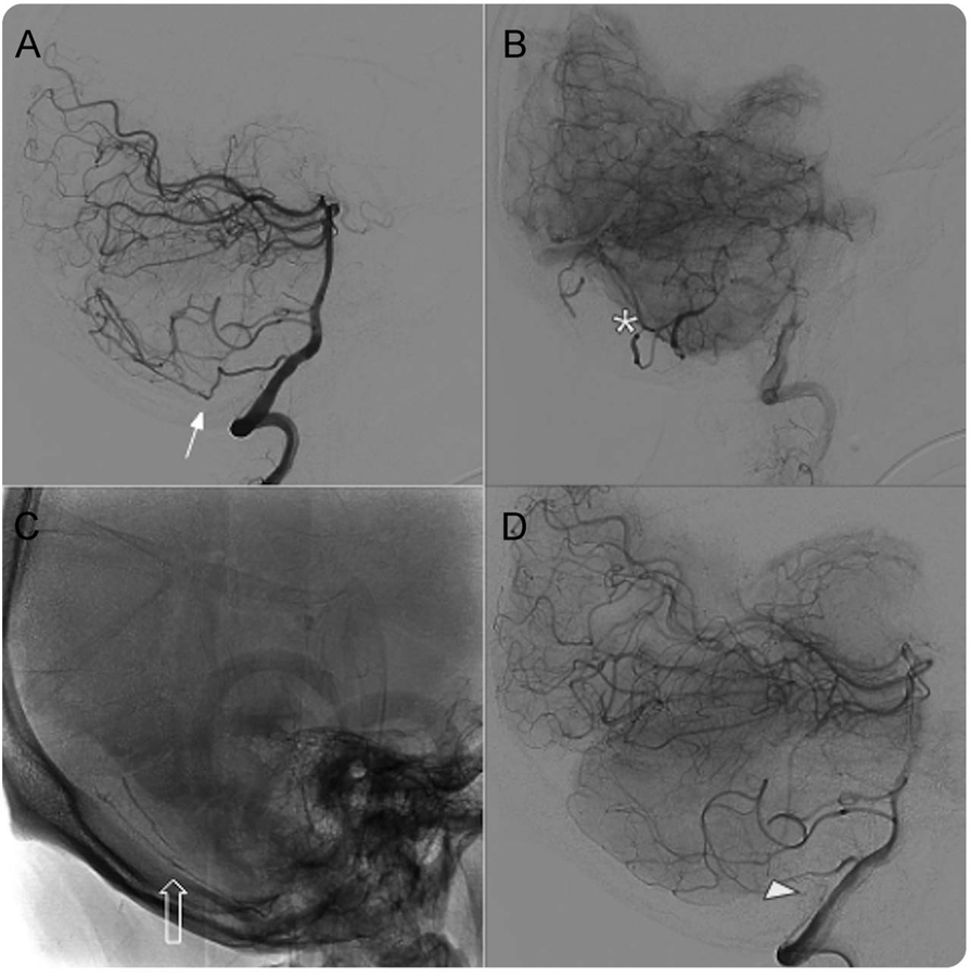 Neurology病例:不易发现的硬脑膜动静脉瘘_经典病例_医脉通