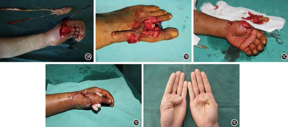 带旋髂浅动脉和皮神经的髂腹股沟皮瓣修复股骨大转子严重骨外露27例_经典病例_医脉通