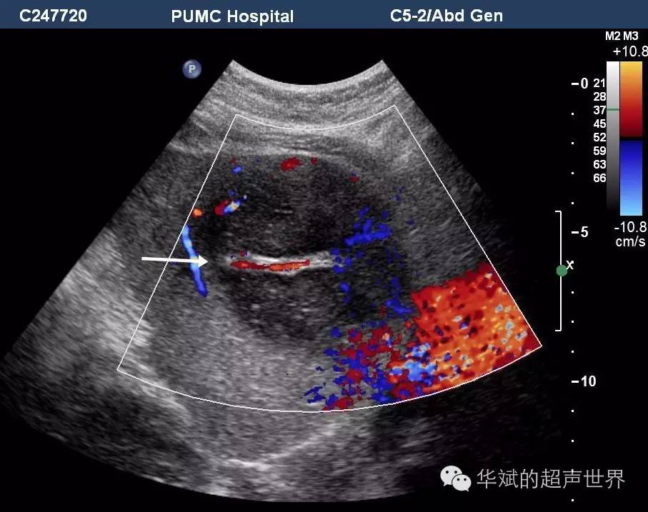 肝脏淋巴瘤之血管漂浮征