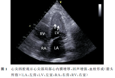 医学新闻 正文 超声心动图示:左室中段至心尖段心内膜回声增强,可见不