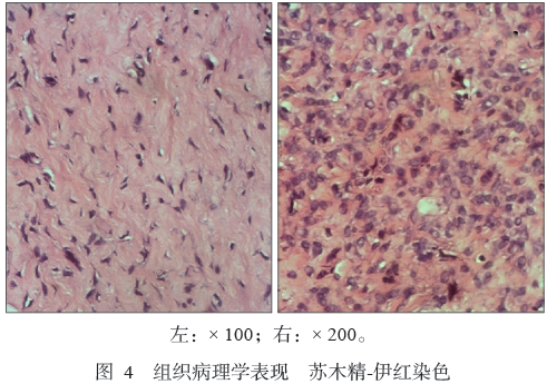 软骨黏液样纤维瘤1例临床病理分析