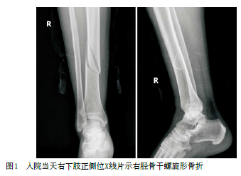 胫骨螺旋形骨折合并后踝骨折1例