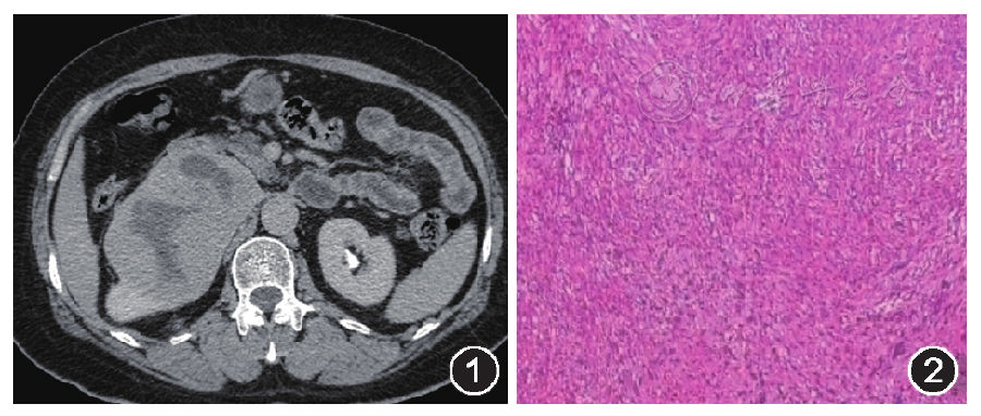 肾神经鞘瘤一例报告
