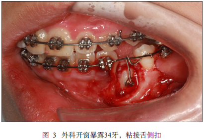 低位乳磨牙伴下颌第一前磨牙水平阻生1例