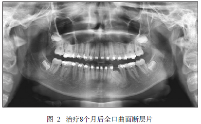 低位乳磨牙伴下颌第一前磨牙水平阻生1例_经典病例_医脉通