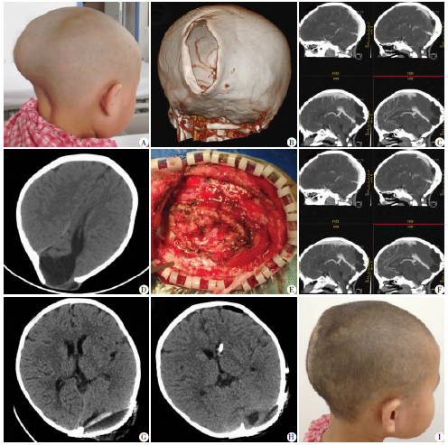 儿童颅骨生长性骨折的临床诊断和治疗