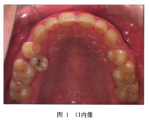 上颌前部骨内埋伏多生牙的定位与手术治疗分析