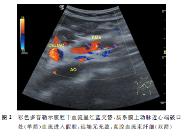 超声提示:孤立性腹腔干夹层,孤立性肠系膜上动脉夹层并血栓形成,建议