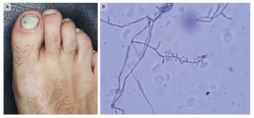 NEJM:HIV感染表现为近端白甲癣-病例报道_经典病例_医脉通