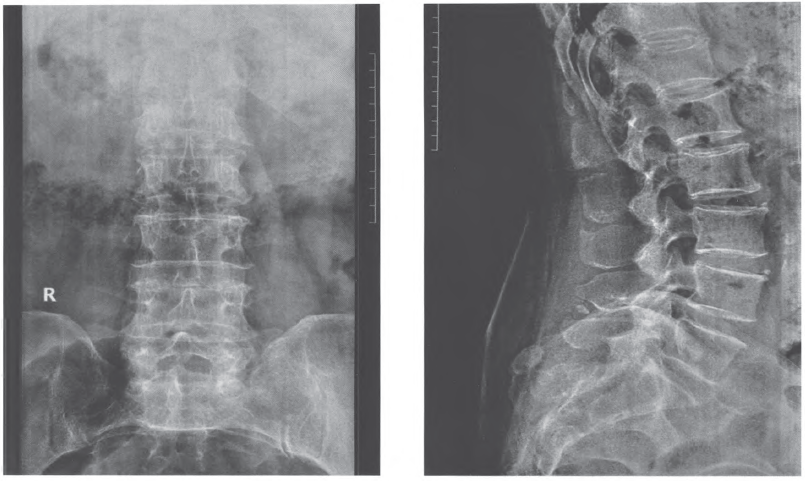 短时程脊髓电刺激治疗带状疱疹后神经感觉异常1例报告_经典病例_医脉通