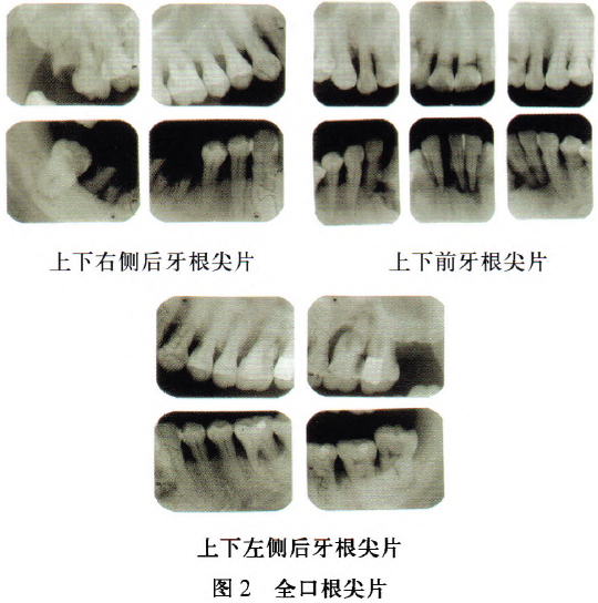 分根术联合纯钛桩核冠保存治疗下颌磨牙残冠残根的临床观察