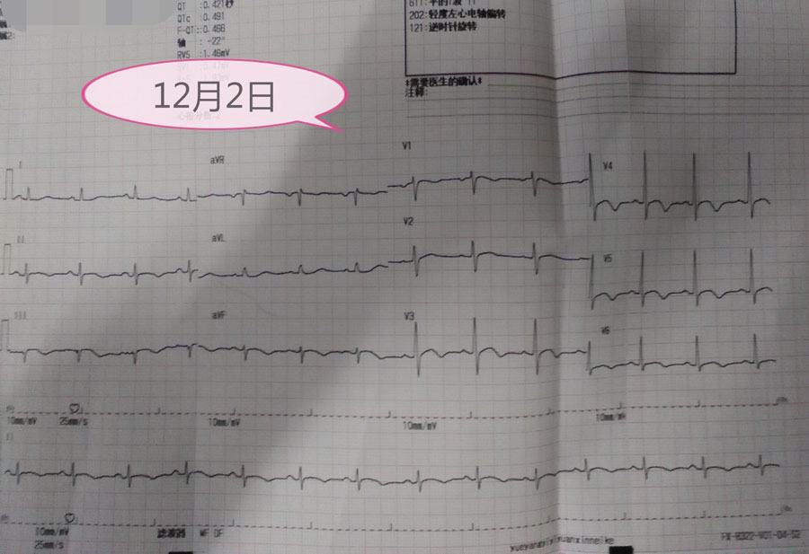 st-t弓背向上抬高 肌钙蛋白阳性=心肌梗死?