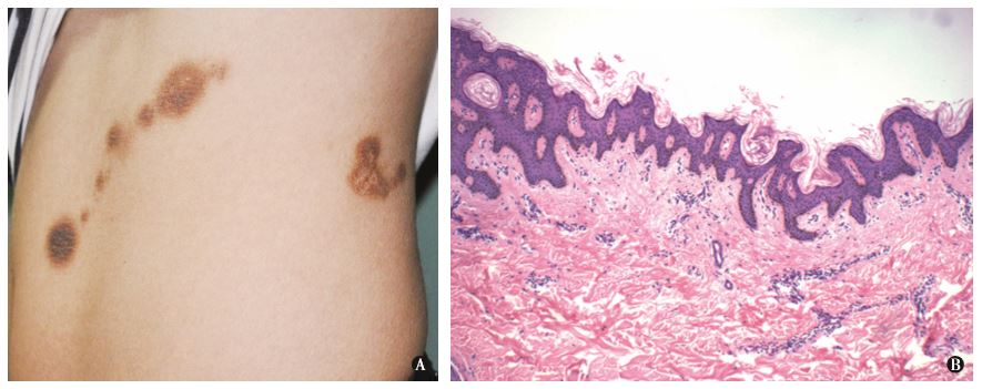 单侧痣样黑棘皮病 - 病例分析 - 医之云病理网