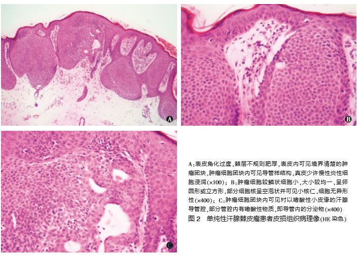 单纯性汗腺棘皮瘤