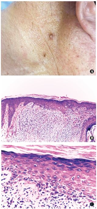 扁平苔藓样角化病 2 例