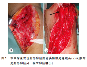 以腓总神经损伤为首发的1型糖尿病1例