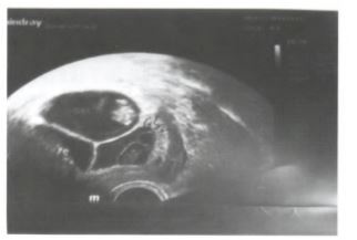 移植2枚冻融胚胎发生单卵单胎合并单卵双胎并