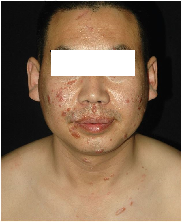 面部,颈部和胸部坚硬丘疹和结节1例