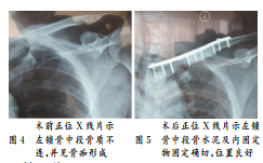 什么是隐匿性骨折症状 15414989385241.png