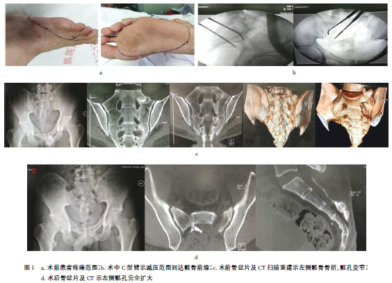 陈旧性骶骨骨折合并骶神经损伤术后1例