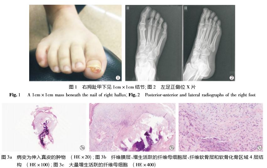 误诊为甲癣的甲下骨疣1 例